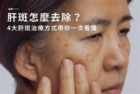 額頭長斑|一次解析曬斑、肝斑、雀斑、顴骨母斑等皮膚黑斑原因…